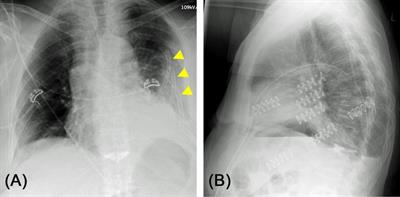 Is it Necessary to Stabilize Every Fracture in Patients with Serial Rib Fractures in Blunt Force Trauma?